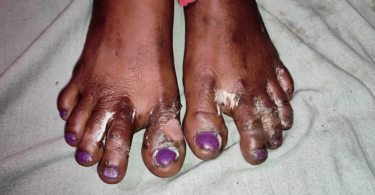 Brutally Attacked for Opposing Jat in Gram Panchayat Polls, Dalit Family Swears to Get Justice